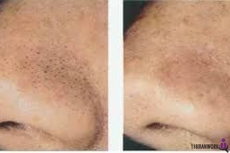 پاکسازی و فشیال پوست سمیه در نیشابور