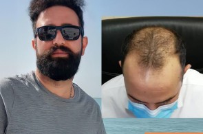 کاشت ابرو زینب حقیقت در شیراز