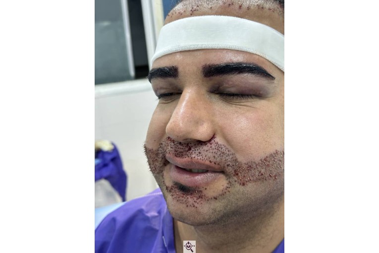 کاشت ابرو زینب حقیقت در شیراز