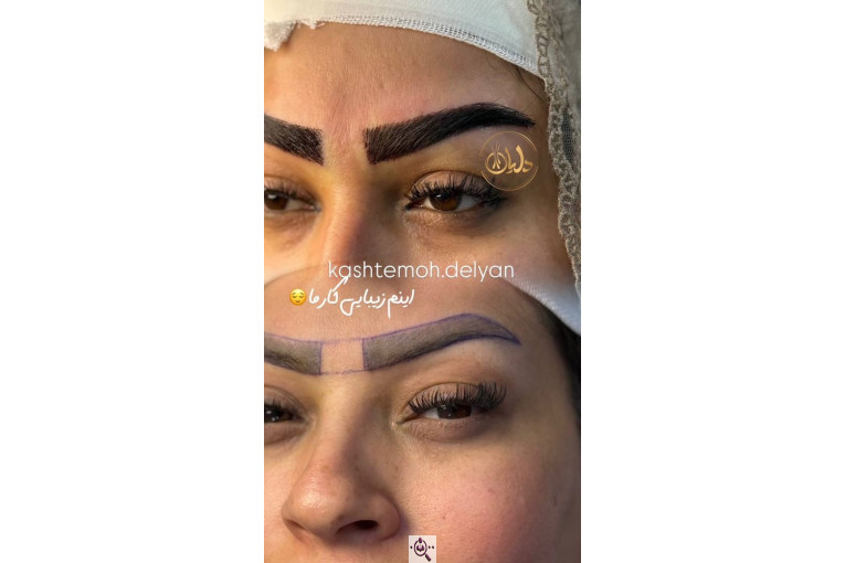 بهترین و پرتراکم ترین کاشت مو و ابرو در اهواز 09129673677