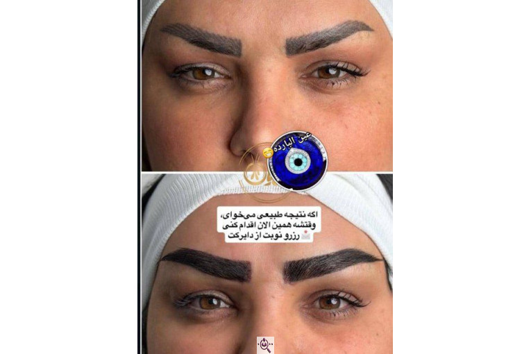 بهترین و پرتراکم ترین کاشت مو و ابرو در اهواز 09129673677