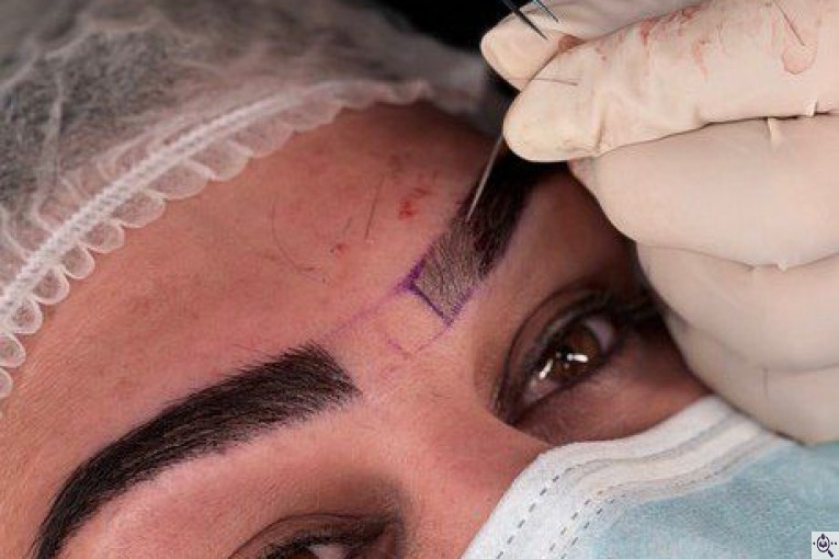 بهترین و پرتراکم ترین کاشت مو و ابرو در اهواز 09129673677
