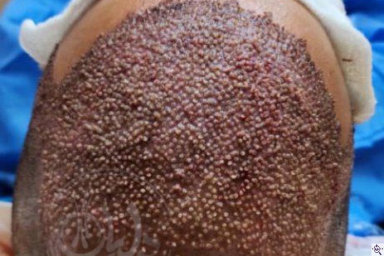 بهترین و پرتراکم ترین کاشت مو و ابرو در اهواز 09129673677
