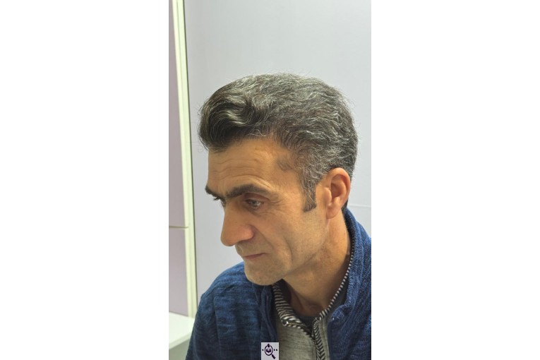 کاشت مو شیخی تبریز