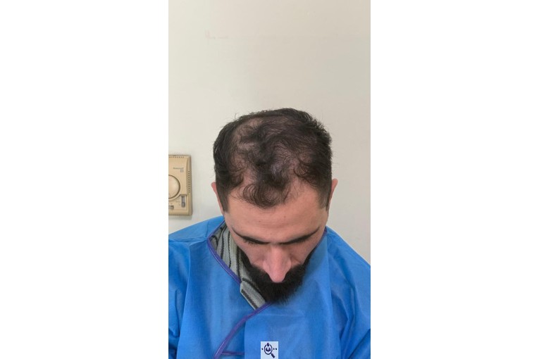 کاشت مو شیخی تبریز