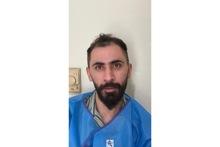 کاشت مو شیخی تبریز