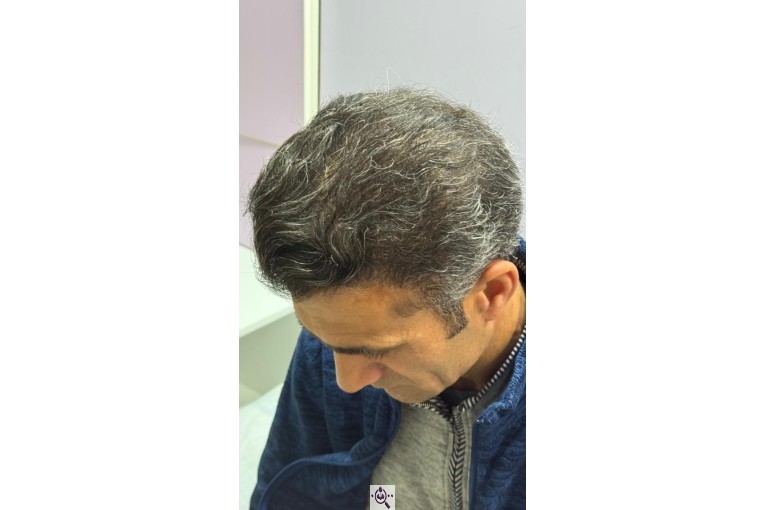 کاشت مو شیخی تبریز