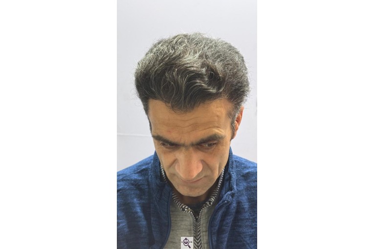 کاشت مو شیخی تبریز
