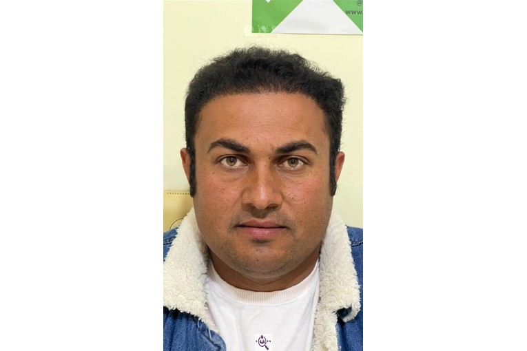 کاشت مو شیخی تبریز