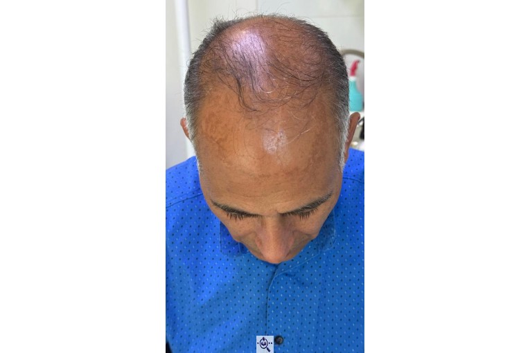کاشت مو شیخی تبریز