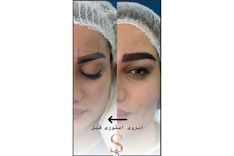 کاشت مو سامره حاجی پور در اهواز
