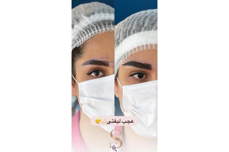 کاشت مو سامره حاجی پور در اهواز