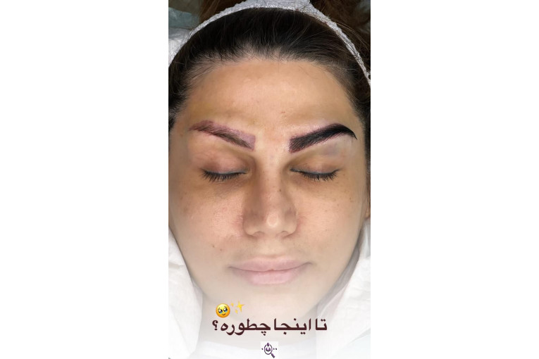 کاشت مو سامره حاجی پور در اهواز