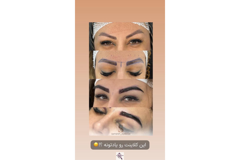 کاشت مو سامره حاجی پور در اهواز