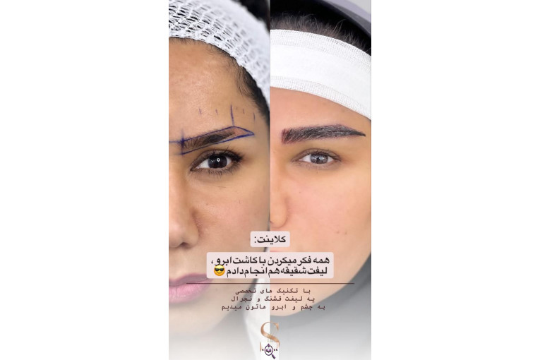 کاشت مو سامره حاجی پور در اهواز