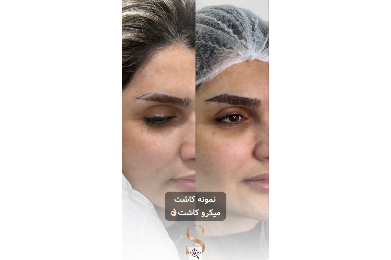 کاشت مو سامره حاجی پور در اهواز