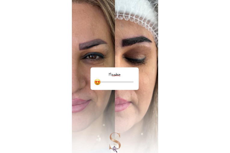کاشت مو سامره حاجی پور در اهواز