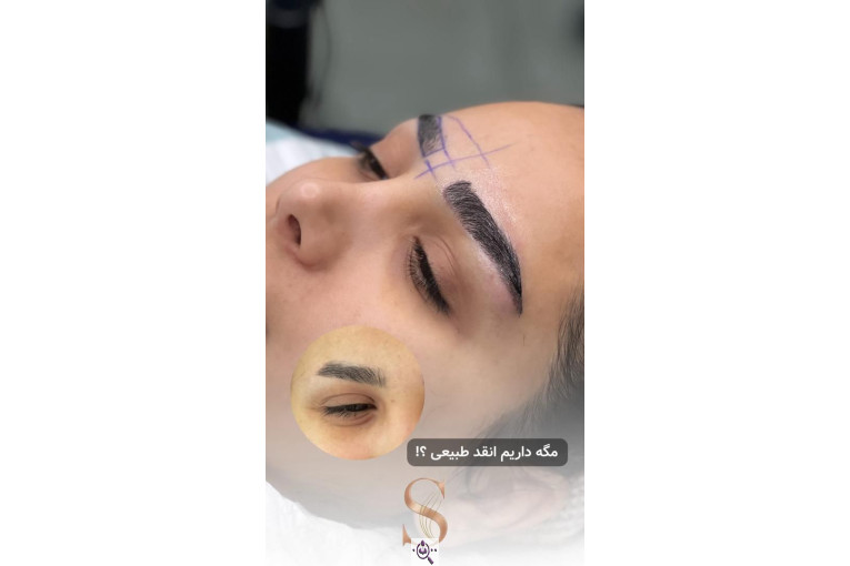 کاشت مو سامره حاجی پور در اهواز