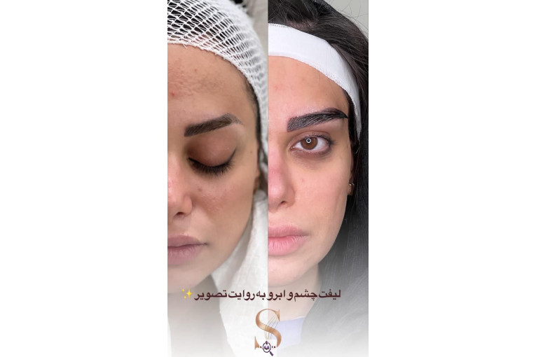 کاشت مو سامره حاجی پور در اهواز