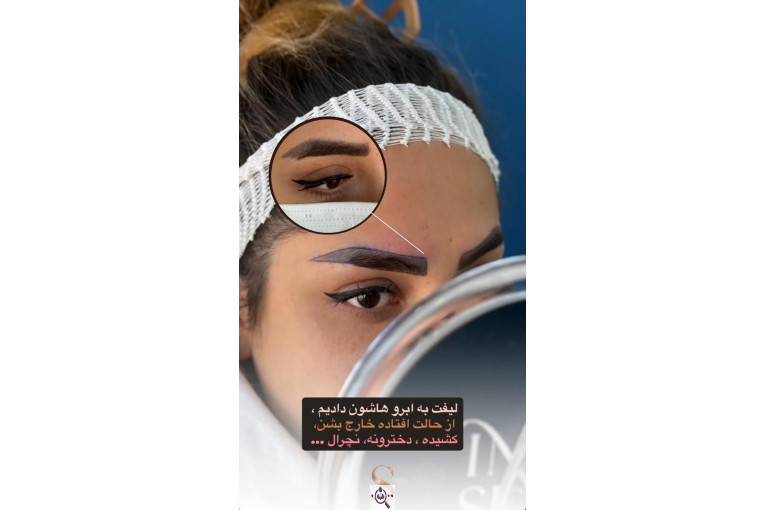 کاشت مو سامره حاجی پور در اهواز