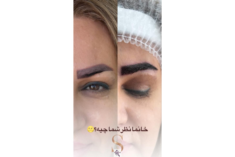 کاشت مو سامره حاجی پور در اهواز