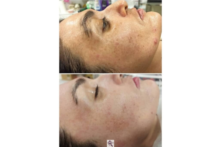 فیشال و پاکسازی پوست الهام حردانی در تهران