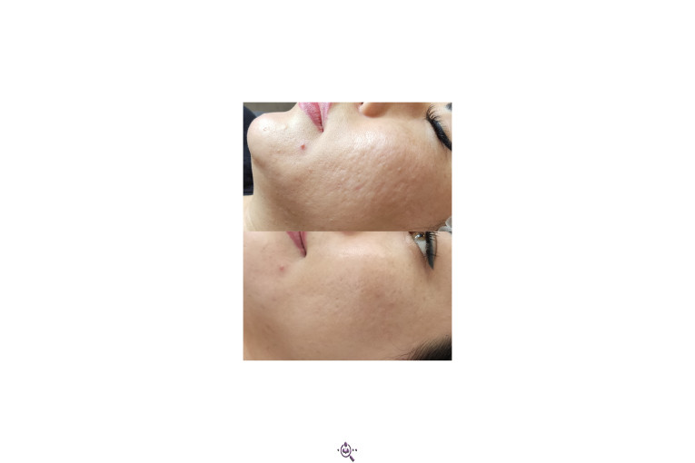 فیشال و پاکسازی پوست الهام حردانی در تهران