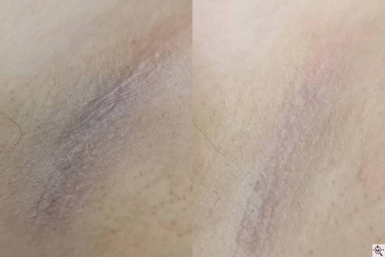 فیشال و پاکسازی پوست الهام حردانی در تهران