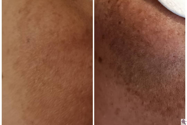 فیشال و پاکسازی پوست الهام حردانی در تهران