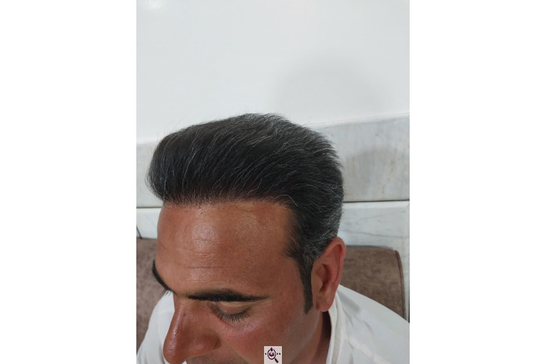 کاشت مو سارینا مجاب در شیراز