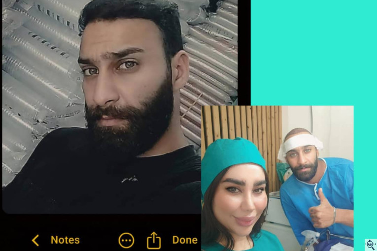 کاشت مو حیدری زاده در اهواز