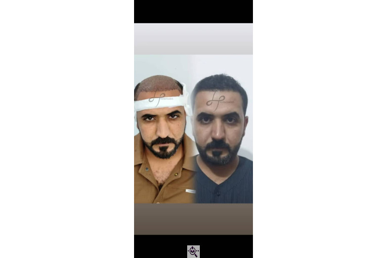 کاشت مو حیدری زاده در اهواز