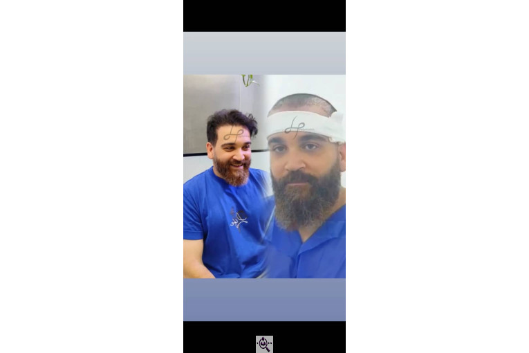 کاشت مو حیدری زاده در اهواز