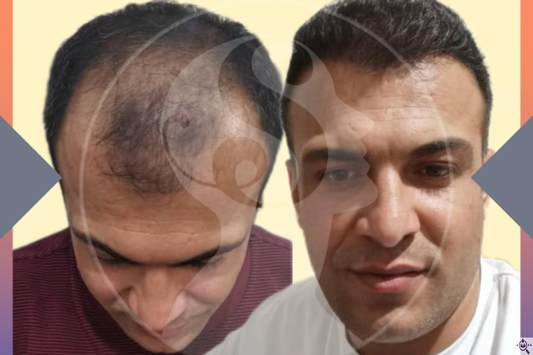 کاشت مو و ابرو سارا حسینی در شیراز