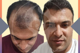 کاشت مو و ابرو سارا حسینی در شیراز