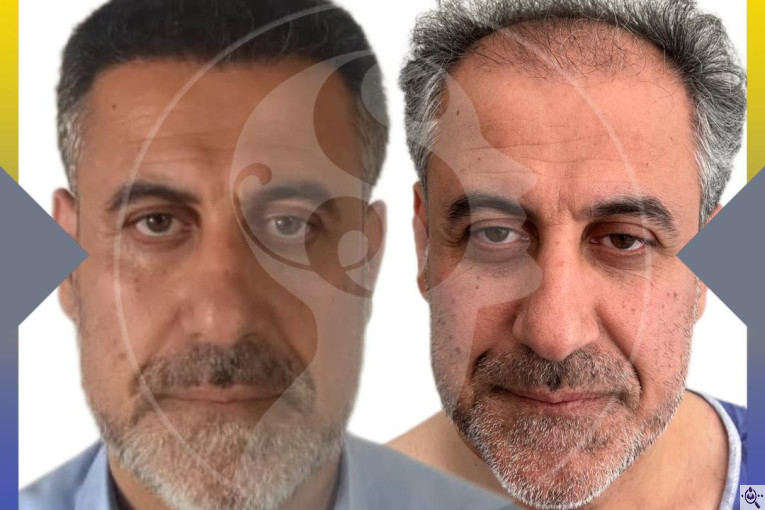 کاشت مو و ابرو سارا حسینی در شیراز