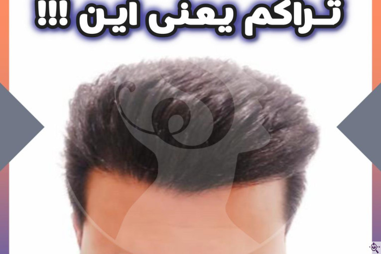 کاشت مو و ابرو سارا حسینی در شیراز