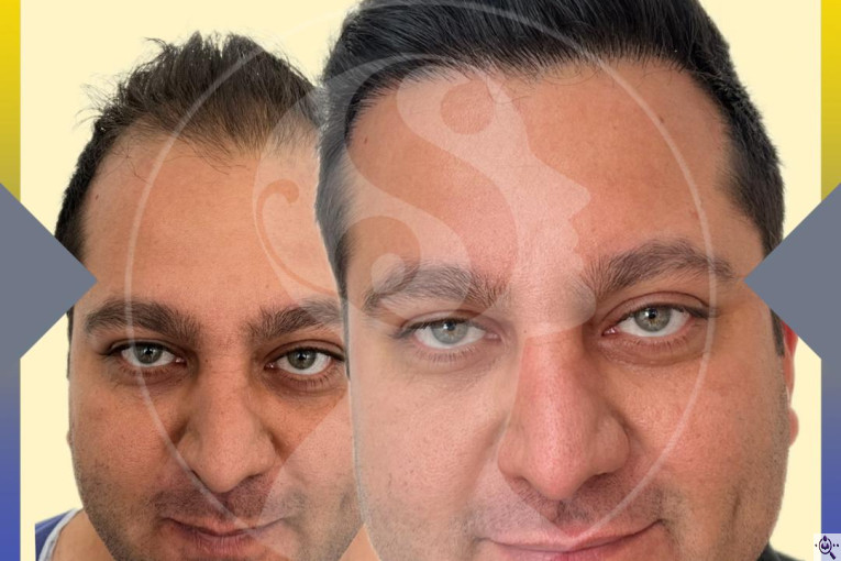 کاشت مو و ابرو سارا حسینی در شیراز