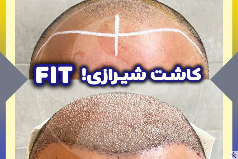کاشت مو و ابرو سارا حسینی در شیراز