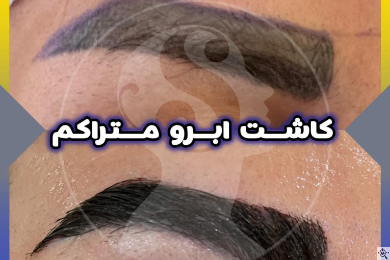 کاشت مو و ابرو سارا حسینی در شیراز