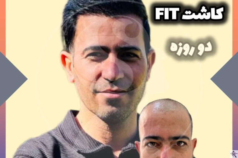 کاشت مو و ابرو سارا حسینی در شیراز