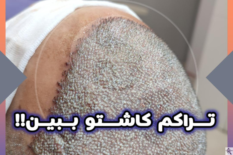 کاشت مو و ابرو سارا حسینی در شیراز