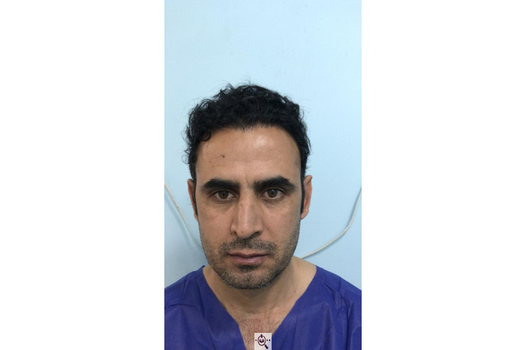 کاشت مو گلزادی در شیراز