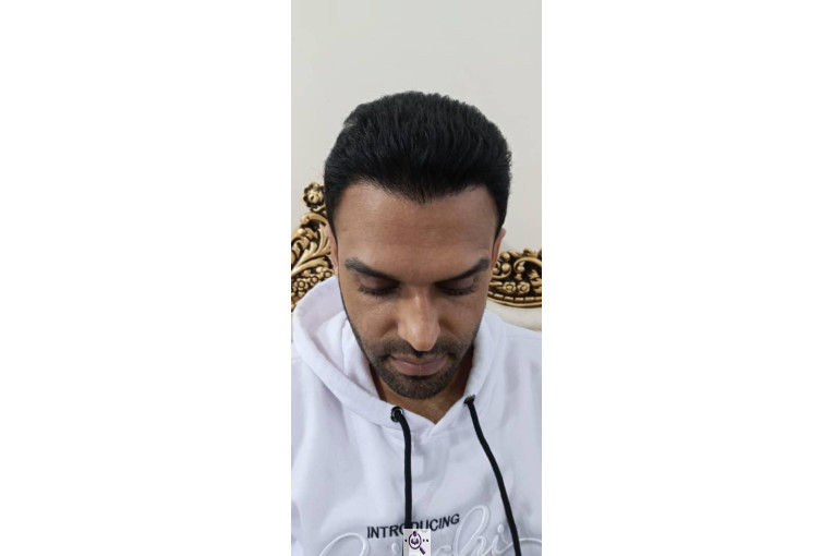 کاشت مو گلزادی در شیراز