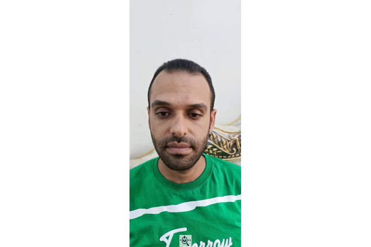 کاشت مو گلزادی در شیراز