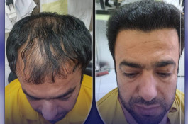 کاشت مو گلزادی در شیراز