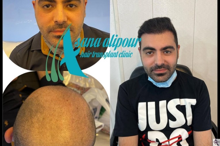 مرکز کاشت مو آسانا علی پور در اهواز