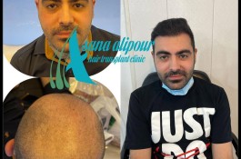 مرکز کاشت مو آسانا علی پور در اهواز