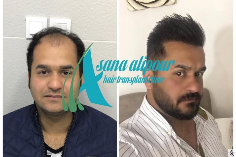 مرکز کاشت مو آسانا علی پور در اهواز