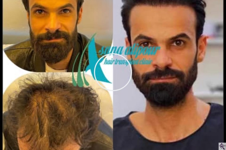 مرکز کاشت مو آسانا علی پور در اهواز